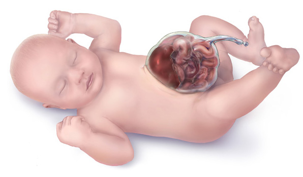 File:Omphalocele-drawing.jpg