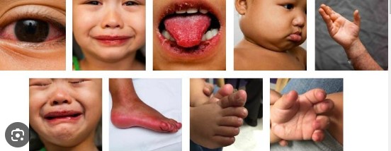 Kawasaki Disease