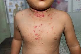 Congo’s Latest Mpox Outbreak