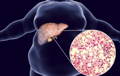 Non-alcoholic Fatty Liver Disease (NAFLD)