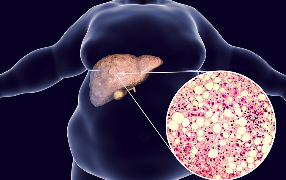 Non-alcoholic Fatty Liver Disease (NAFLD)