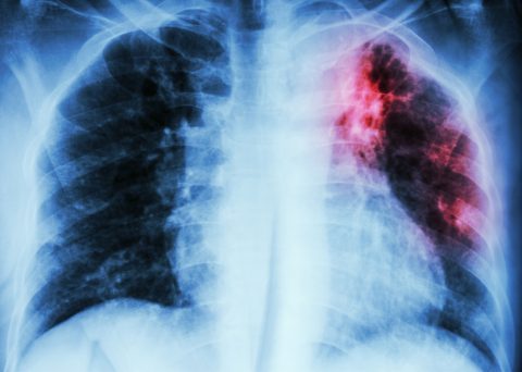 World Tuberculosis Day 2026